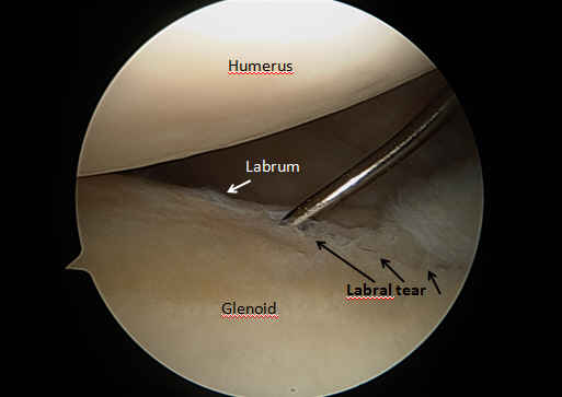 shoulder labrum anatomy tears tear dislocation labral